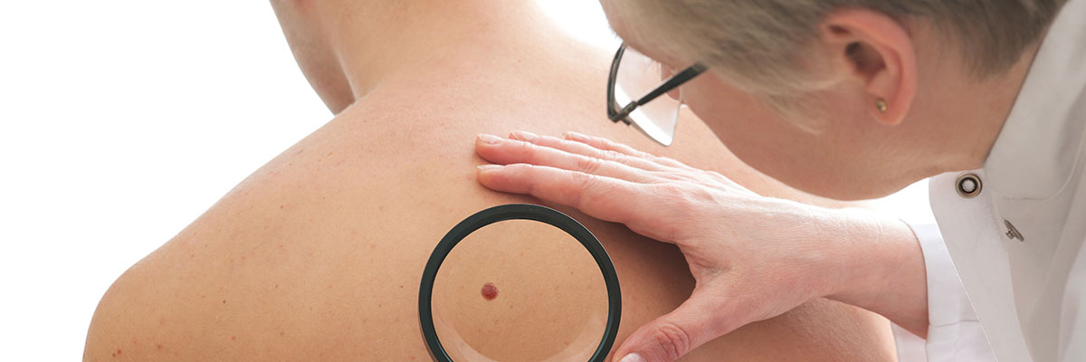 biomarcador del melanoma