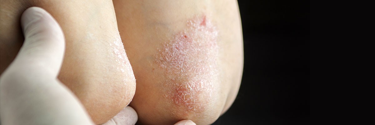 psoriasis