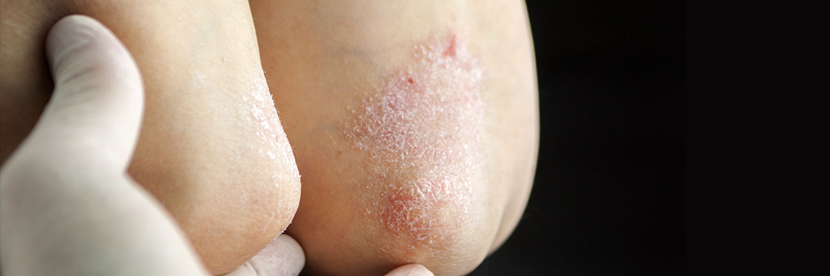 psoriasis