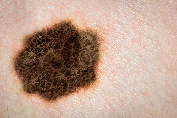 Registro de melanoma