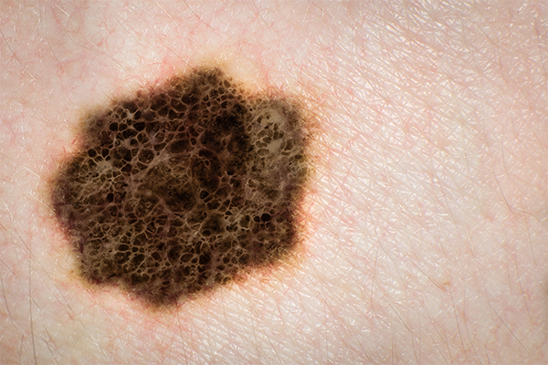 día mundial melanoma