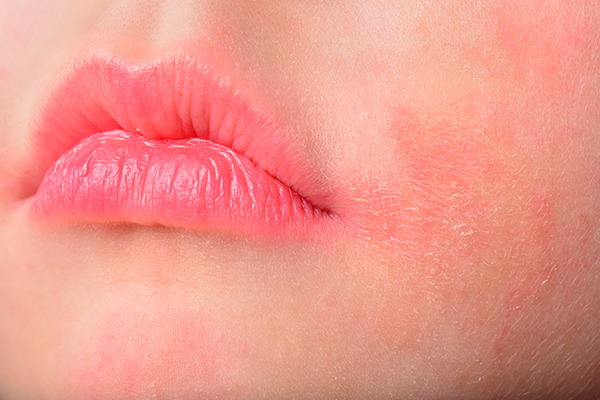 dermatitis atópica