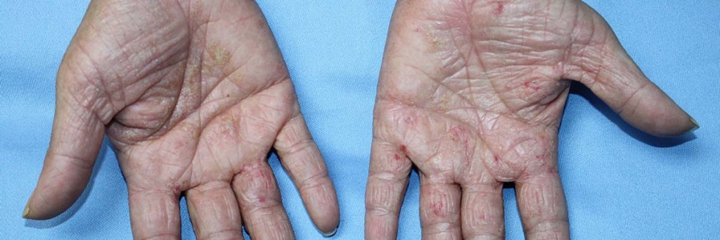 Becas para asistir a la 62º Reunión del Grupo Español en Investigación de Dermatitis de Contacto y Alergia Cutánea