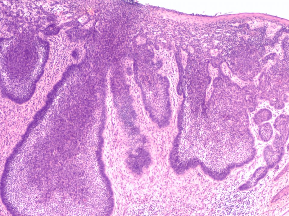 Imagen de una biopsia de un carcinoma basocelular.