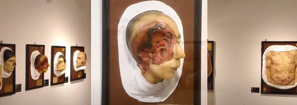 epitelioma-museo