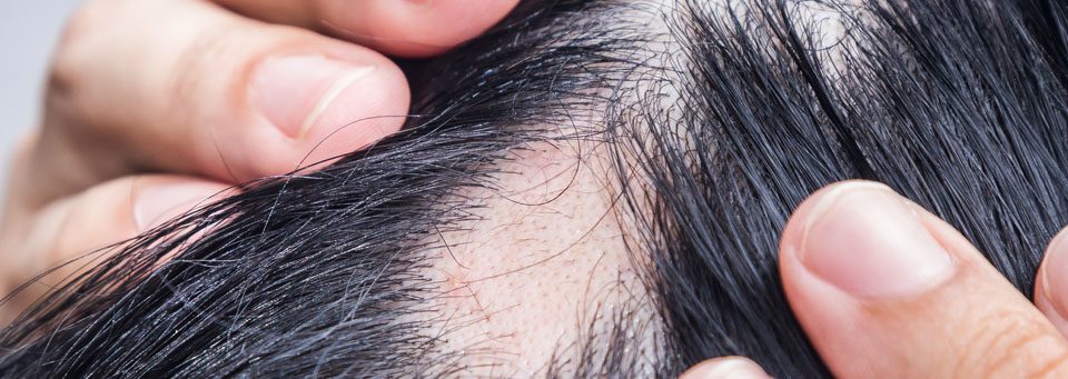 alopecia