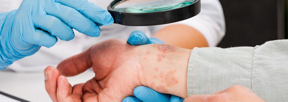 dia-mundial-psoriasis
